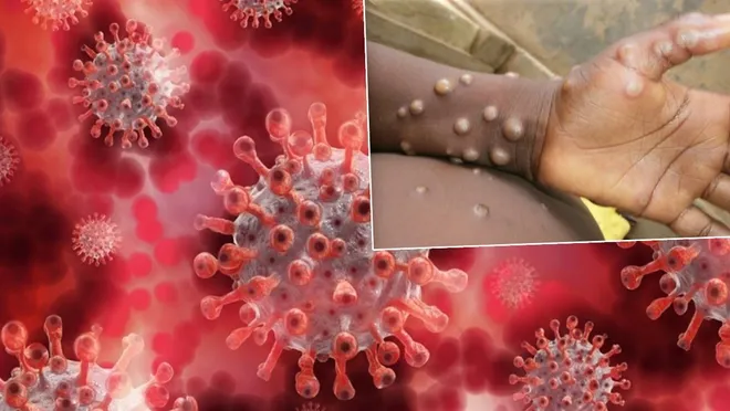 DSÖ’den kritik Maymun çiçeği açıklaması: M çiçeği virüsü kontrol altına alınabilir mi?